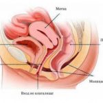 Опущение органов малого таза: симптомы и лечение