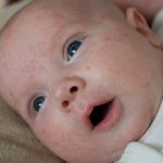Сыпь на лице у ребенка: причины возникновения и рекомендации