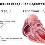 Хроническая сердечная недостаточность: симптомы и лечение